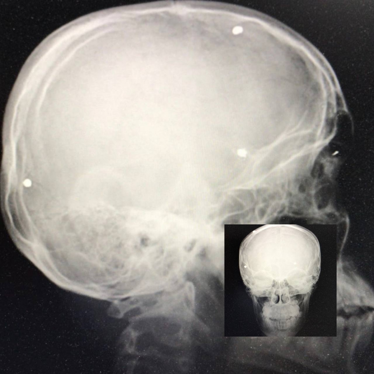 В Сургуте врачи извлекли дробь из мозга ребёнка